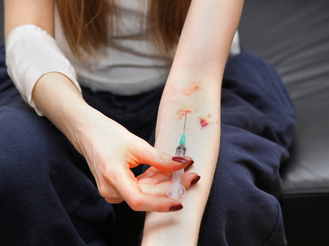 A heroin addict using a needle to shoot the drug into her bruised and scarred arm (Credit: Tatty via Fotolia)