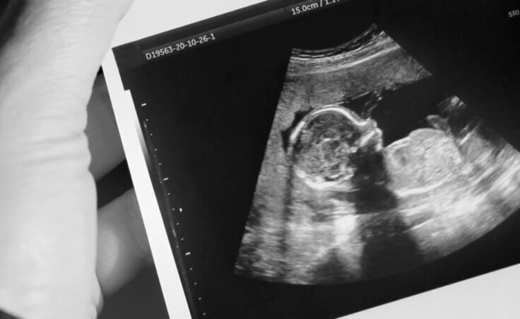 Sonogram photo of baby in utero By Alfons Photographer/stock.adobe.com