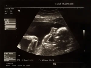 Ultrasound picture of a baby in utero. By Mikael Damkier/stock.adobe.com