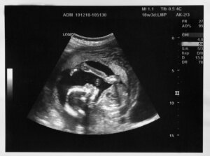 Ultrasound of fetus. By strelov/stock.adobe.com